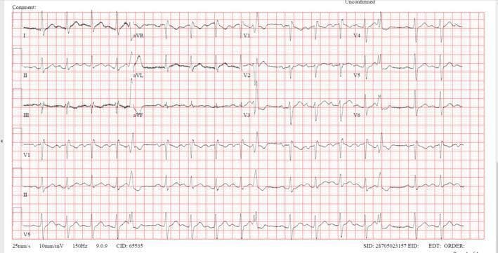 This diagnostic image is a 12-lead electrocardiogram (ECG) demonstrating sinus tachycardia with features of an incomplete right bundle branch block (RBBB). The tracing shows a regular rhythm with an elevated heart rate exceeding 100 beats per minute. Key morphological findings include an RSR' pattern in lead V1 and widened, slurred S waves in the lateral leads (I, aVL, V5, and V6), characteristic of delayed right ventricular conduction. The QRS duration is slightly prolonged. Significant ST-segment abnormalities are present, specifically ST depression in the inferior leads (II, III, and aVF) and ST elevation in lead aVR. These findings, in the clinical context of right ventricular strain, are often associated with acute pulmonary embolism. The PR and QT intervals appear within normal limits. This ECG serves as an educational example of conduction delays and secondary repolarization changes in the setting of acute cardiovascular pathology.