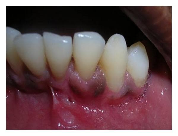 This intraoral clinical photograph shows a postoperative view of the mandibular left quadrant, focusing on the successful surgical treatment of gingival recession on the lower left lateral incisor (tooth 32). The image demonstrates complete root coverage following a periodontal plastic surgery procedure, likely involving a subepithelial connective tissue graft and a double pedicle flap. The gingival margin at tooth 32 is positioned at the cemento-enamel junction (CEJ), matching the level of adjacent teeth. The interdental papillae are well-formed and fill the proximal spaces. The newly formed keratinized tissue appears pink, healthy, and firm, with a smooth texture and a clearly defined mucogingival junction. No clinical signs of inflammation, such as edema or erythema, are visible. The neighboring mandibular teeth appear clean with smooth enamel surfaces and an absence of plaque or calculus deposits. This visual serves as a clinical example of regenerative periodontal therapy achieving both functional attachment and esthetic harmony in the treatment of Miller's Class II recession.