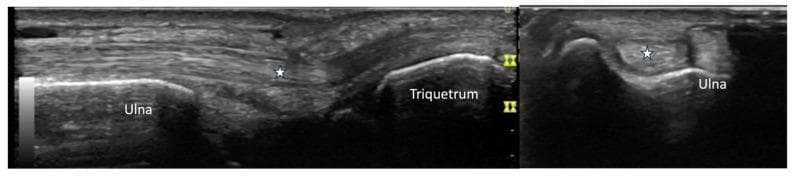 Two grayscale musculoskeletal ultrasound images display the extensor carpi ulnaris (ECU) tendon at the ulnar aspect of the wrist in two orthogonal planes. The left image shows a long-axis (longitudinal) view, where the ECU tendon (marked with a white star) appears as a hyperechoic, fibrillar structure extending superficially over the distal ulna and triquetrum. The cortical margins of both the ulna and triquetrum are well-defined, smooth, and continuous, showing no evidence of erosions or osteophytes. The right image provides a short-axis (transverse) view, depicting the ECU tendon (white star) as an oval, echogenic structure nestled within the ulnar groove of the distal ulna. There is no significant anechoic fluid or synovial thickening visible around the tendon in either view, suggesting a normal sonographic appearance. This imaging is commonly used to evaluate for tenosynovitis, tendon subluxation, or underlying cortical irregularities in rheumatological conditions like systemic sclerosis or rheumatoid arthritis.