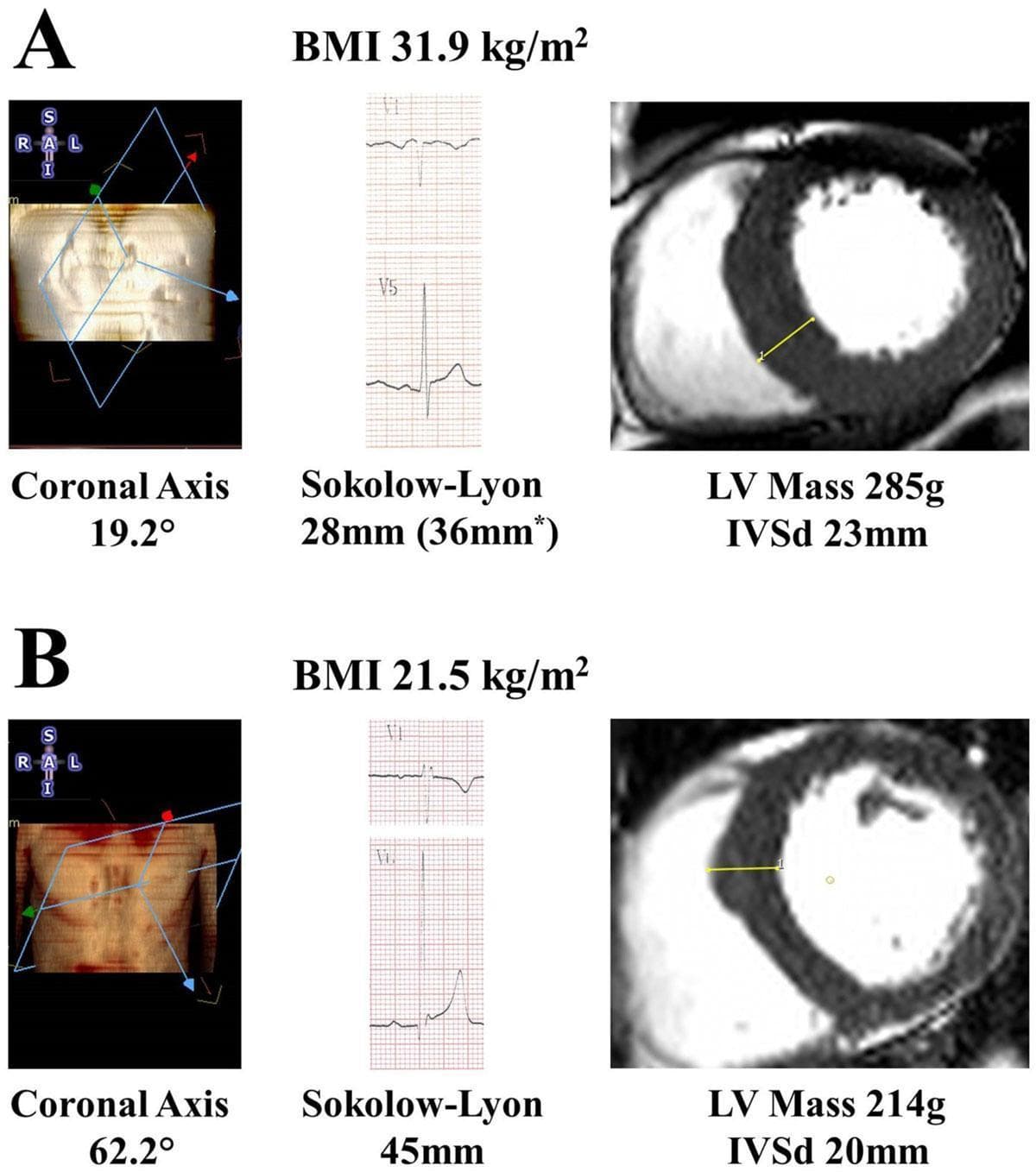 This comparative medical illustration demonstrates the impact of body mass index (BMI) and anatomical orientation on electrocardiogram (ECG) voltage criteria for left ventricular hypertrophy (LVH). The figure compares two subjects (A and B) using a combination of three modalities: torso geometry diagrams, surface ECG leads (V1 and V5), and cardiac MRI short-axis views. Subject A (obese, BMI 31.9 kg/m²) shows a higher left ventricular (LV) mass (285g) and interventricular septal diastolic thickness (IVSd 23mm) on MRI, yet displays lower Sokolow-Lyon voltage (28mm) on ECG. This is contrasted with Subject B (normal weight, BMI 21.5 kg/m²), who has a lower LV mass (214g) but a significantly higher Sokolow-Lyon voltage (45mm). The anatomical diagrams illustrate a difference in the coronal axis (19.2° vs 62.2°), highlighting how torso habitus and cardiac orientation can attenuate electrical signals measured at the skin surface. The image serves as an educational tool for cardiology and radiology, emphasizing that anatomical factors and obesity can reduce the diagnostic sensitivity of standard surface ECG criteria despite the presence of significant structural hypertrophy.