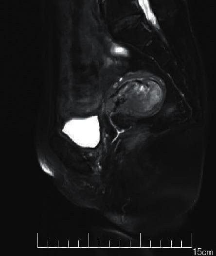 This diagnostic image is a sagittal T2-weighted MRI (T2WI) of the female pelvis, demonstrating a submucosal uterine fibroid (leiomyoma). The uterus is the central focus, containing a well-defined, nodular, and predominantly low-signal (hypointense) mass characteristic of fibrous tissue. The fibroid is situated within the endometrial cavity, consistent with a submucosal classification. Its boundaries are demarcated by a relatively hyperintense rim, although some areas appear less distinct, potentially suggesting localized hemorrhage or edema. Anterior to the uterus, the urinary bladder is highly visible, exhibiting intense high signal (hyperintensity) due to the presence of fluid (urine) on this imaging modality. The surrounding pelvic soft tissues and musculature display intermediate signal intensities. This image is an educational example used in gynecology and radiology to teach the identification of benign uterine tumors, their impact on the endometrial cavity, and the signal characteristics of leiomyomas relative to surrounding anatomical structures like the bladder.