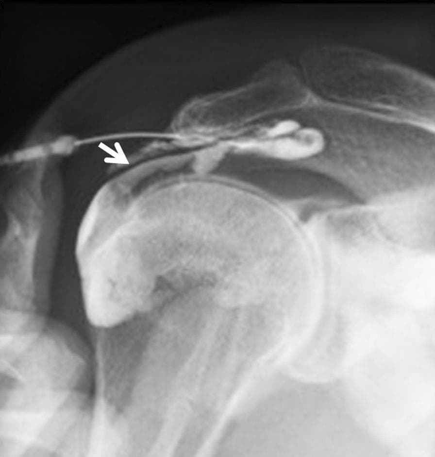 This diagnostic image is a subacromial bursography (fluoroscopic radiograph) of a human shoulder. The imaging modality highlights the subacromial space using radiopaque contrast medium. The bony anatomy includes the humeral head, greater tubercle, and the overlying acromion process. A needle is visible, through which contrast was administered. The key finding is a localized, abnormal accumulation or 'pooling' of contrast medium extending inferiorly from the subacromial bursa into the rotator cuff tendon area (indicated by a white arrow). This visual pattern is diagnostic of a bursal-side partial-thickness rotator cuff tear, specifically involving the infraspinatus or supraspinatus tendons, where the contrast fills the defect in the tendon fibers. The image demonstrates a critical diagnostic step for patients with refractory shoulder impingement syndrome where standard MRI findings might appear normal. It serves as an educational example of how dynamic contrast-enhanced imaging can reveal occult tendon pathology not seen on static radiography.