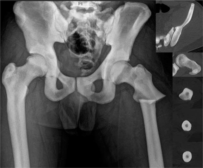 This composite diagnostic image features an anteroposterior (AP) radiograph of the pelvis and bilateral femurs, supplemented by axial computed tomography (CT) insets. The primary finding is diffuse, generalized osteosclerosis characteristic of autosomal dominant type II osteopetrosis (Albers-Schönberg disease). The bones exhibit markedly increased radiodensity, resulting in a 'chalk-like' appearance and loss of normal corticomedullary differentiation. A distinctive 'bone-within-bone' (endobone) appearance is visible in the pelvic bones and vertebral elements. The medullary canals of the femurs are severely narrowed or obliterated by dense sclerotic bone. A displaced subtrochanteric fracture is evident in the left femur. The axial CT insets at the level of the femoral shaft confirm the increased cortical thickness and high-density central marrow space, illustrating the extreme bone hardness associated with this metabolic condition. These images provide critical educational context regarding the challenges of intramedullary nail placement in patients with osteopetrosis due to the lack of a patent medullary canal.