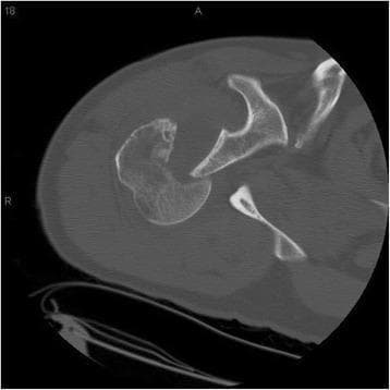 This diagnostic image is an axial computed tomography (CT) scan of the right shoulder, showing the glenohumeral joint. The image demonstrates a posterior shoulder dislocation, characterized by the humeral head being displaced posteriorly relative to the glenoid fossa. A significant impaction fracture is visible on the anteromedial aspect of the humeral head, representing a reverse Hill-Sachs lesion, which commonly occurs when the anterior humeral head strikes the posterior glenoid rim during a posterior dislocation event. The glenoid fossa itself appears to have an intact cortical outline without evidence of an associated bony Bankart lesion or significant fracture in this view. This scan is educationally significant for identifying the typical radiological findings of chronic or locked posterior shoulder instability and the secondary osseous defects resulting from mechanical impaction.