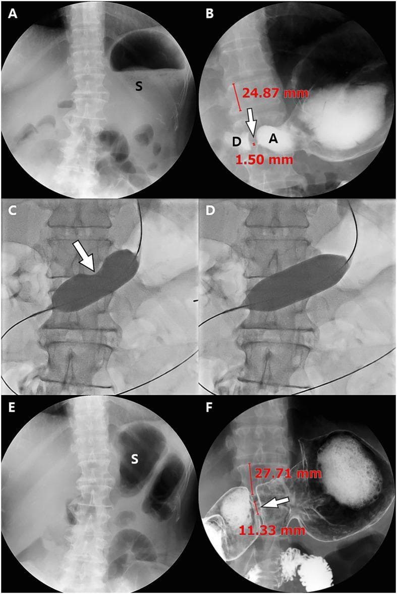 This composite of abdominal radiographic and fluoroscopic images demonstrates the management of impaired pyloric function following a pylorus-preserving gastrectomy (PPG). Panel A (scout) and B (Upper GI Series - UGIS) show pre-procedural state, highlighting significant gastric stasis with residual food (S) and severe narrowing of the pyloric canal (1.50 mm) between the antrum (A) and duodenum (D). Panels C and D provide intra-procedural fluoroscopic visualization of balloon dilatation. Panel C shows an 'hourglass deformity' (arrow) of the balloon at the point of stenosis, which resolves in Panel D upon full inflation, indicating successful dilatation. Panels E and F show the post-procedural follow-up at 11 months. The scout image (E) shows a marked reduction in residual gastric food material. The follow-up UGIS (F) demonstrates a patent, dilated pyloric canal measuring 11.33 mm. Quantitative assessment is provided by comparing the pyloric width to the height of the adjacent vertebral body (24.87 mm vs 27.71 mm). The series illustrates the clinical utility of interventional radiology in treating post-operative gastric outlet obstruction via balloon dilatation.