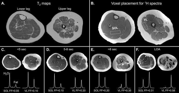 This composite diagnostic image demonstrates muscle pathology in the lower extremities using MRI and proton Magnetic Resonance Spectroscopy (1H MRS). Panel A displays axial T2 maps of the lower leg (calf) and upper leg (thigh), showcasing muscle segmentation for T2 relaxation time analysis. Panel B shows T1-weighted images identifying voxel placement for 1H MRS within the soleus (SOL) and vastus lateralis (VL) muscles. Panels C-F illustrate a progressive clinical spectrum of Duchenne Muscular Dystrophy (DMD) or similar myopathy, organized by functional ambulatory status (10m walk/run times: <5s, 5-8s, >8s, and Loss of Ambulation/LOA). These panels correlate T1-weighted anatomical imaging with MR spectra and Fat Fraction (FF) values. Visually, there is a clear progression of high-intensity signal within the muscle compartments, representing fibrofatty replacement. This infiltration is confirmed by the 1H MRS peaks, where the fat-to-water ratio increases significantly from panel C (FF 0.05-0.10) to panel F (FF 0.31-0.58), correlating increased fatty infiltration with decreased ambulatory function.