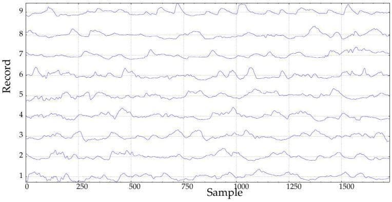 This Comparison Chart displays nine sequential time-series records (labeled Record 1 to 9) representing continuous blood glucose monitoring (CGM) data from patients ten months post-implantation of a Duodenal-Jejunal Bypass Liner (DJBL). The records are arranged vertically as individual line graphs against a horizontal 'Sample' axis ranging from 0 to over 1500 units, representing a minimum duration of six days. Each graph illustrates the dynamic fluctuations, amplitude, and frequency of glucose levels over time. Distinctive visual features include varying degrees of complexity and volatility across the records; for instance, Records 1 and 6 show pronounced spikes and oscillations, whereas Records 7 and 8 demonstrate more stable physiological trends. This visual dataset is used in endocrine research to evaluate glucose variability and metabolic control through entropy-based metrics (SampEn and FuzzyEn). The image serves as a clinical reference for physiological signal processing and the longitudinal assessment of glycemic regulation following metabolic surgical interventions in obese, diabetic populations.