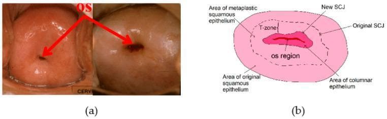 This composite educational graphic focuses on cervical anatomy and visual screening for gynecological health. Section (a) features two clinical cervigrams (endoscopic cervical photographs) demonstrating morphological variations of the external os. The first photograph shows a small, circular nulliparous os, while the second shows a larger, more irregular opening. Red arrows highlight the os in both clinical examples. Section (b) is an anatomical diagram of the cervix illustrating key histological regions and zones. It identifies the central 'os region' surrounded by the 'area of columnar epithelium.' The diagram further delineates the 'squamocolumnar junction (SCJ),' showcasing its physiological migration with age from an 'original SCJ' to a 'new SCJ' position. The 'transformation zone (T-zone)' is labeled between these two junctions, within the 'area of metaplastic squamous epithelium.' The peripheral region is identified as the 'area of original squamous epithelium.' This visual aid is designed to teach cervical topography and the clinical significance of the T-zone as the primary site for neoplastic development and colposcopic evaluation.