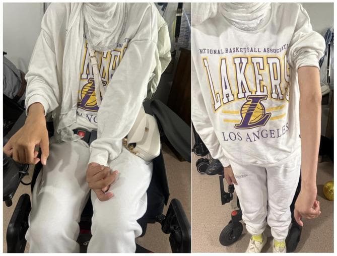 This clinical photograph consists of two side-by-side panels showing an individual in a seated position, illustrating movement disorder manifestations. The left panel shows the patient seated in a wheelchair, demonstrating a characteristic dystonic posture of the left upper extremity. This posturing is characterized by fixed internal rotation of the left shoulder and flexion at the elbow. In contrast, the right upper extremity appears more extended and relaxed. The right panel provides a closer view of the torso and limbs, highlighting the asymmetry between the flexed left arm and the extended right arm. The image serves as a visual representation of neurological signs associated with Woodhouse-Sakati Syndrome (WSS), specifically secondary dystonia and impaired mobility. The patient exhibits a female phenotype, though contextually noted for poor secondary sexual development. These images are medically significant for identifying phenotypic clinical signs of biallelic pathogenic variants in the DCAF17 gene, which manifest as progressive extrapyramidal symptoms and cognitive impairment.