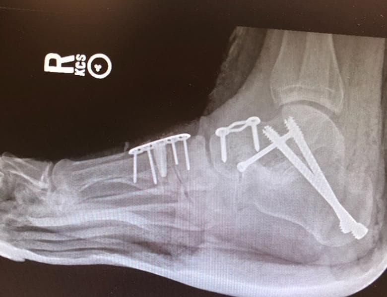 This lateral radiographic image of a right foot demonstrates extensive orthopedic internal fixation hardware following reconstructive surgery, likely a triple arthrodesis and medial column stabilization. In the hindfoot, three large, fully threaded compression screws are visible, inserted from the posterior-inferior calcaneus and extending superior-anteriorly across the subtalar joint into the talus. The midfoot shows a dorsally placed, rectangular multi-hole neutralization plate secured with four screws. Centrally, a two-hole compression staple or plate is visible across the talonavicular or calcaneocuboid region. Notably, a radiopaque titanium wedge is positioned at the first tarsometatarsal joint (Cotton osteotomy or similar) to achieve plantarflexion of the first ray. The image illustrates complex surgical management of rigid foot deformities, such as pes planovalgus or neuromuscular collapse, highlighting the use of diverse metallic implants to maintain correction and facilitate osseous fusion while preventing medial column shortening.