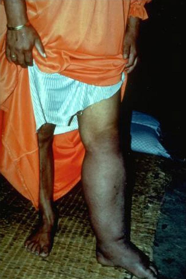 This clinical photograph displays a comparative view of a patient's lower extremities, illustrating severe, unilateral lymphedema, a condition commonly associated with lymphatic filariasis (elephantiasis). The patient's left leg exhibits massive, non-pitting edema extending from the thigh to the foot, resulting in a significantly increased circumference and a loss of normal anatomical contour. The skin on the affected limb is notably darker, showing a dusky, hyperpigmented coloration and a taut, thickened texture compared to the contralateral limb. In stark contrast, the right leg appears normal in size and skin tone, emphasizing the severity of the pathology on the left. This visual serves as an educational example of chronic lymphatic obstruction caused by parasitic filarial nematodes, demonstrating the late-stage physical manifestations and skin changes associated with lymphatic dysfunction and secondary tissue fibrosis.