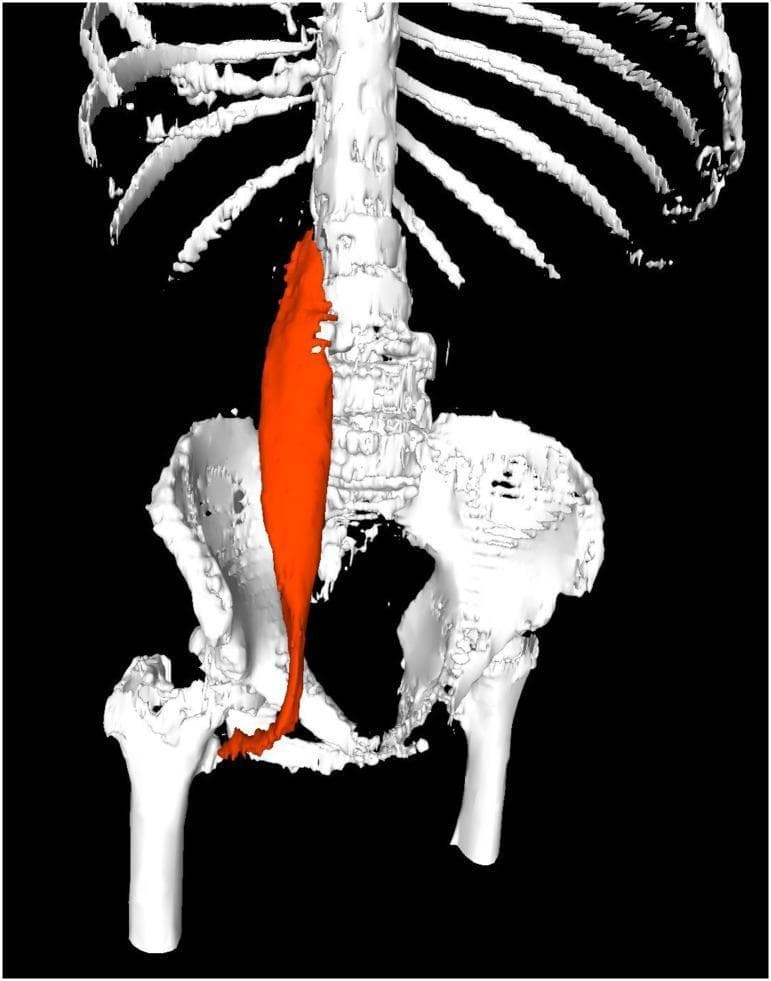 This diagnostic image is a 3D volume-rendered reconstruction derived from a CT scan, illustrating the musculoskeletal anatomy of the posterior abdominal wall and pelvis. The primary educational focus is the psoas major muscle, which is digitally segmented and highlighted in orange on the right side of the anatomical model (patient's left). The skeletal framework displays the lower rib cage, the lumbar vertebral column (L1-L5), the complete bony pelvis (including ilium, ischium, and pubis), and the proximal femurs. The psoas major is shown originating from the lateral aspects of the T12 and lumbar vertebrae, coursing inferiorly and laterally over the pelvic brim and anterior to the sacroiliac joint. It terminates at its insertion point on the lesser trochanter of the proximal femur. This visual is used in clinical research to demonstrate the measurement of Psoas Muscle Volume (PMV) and Psoas Muscle Index (PMI), which serve as radiological markers for sarcopenia and are prognostic indicators in oncological outcomes. The rendering clearly depicts the spatial relationship between the axial skeleton and the major hip flexor musculature.
