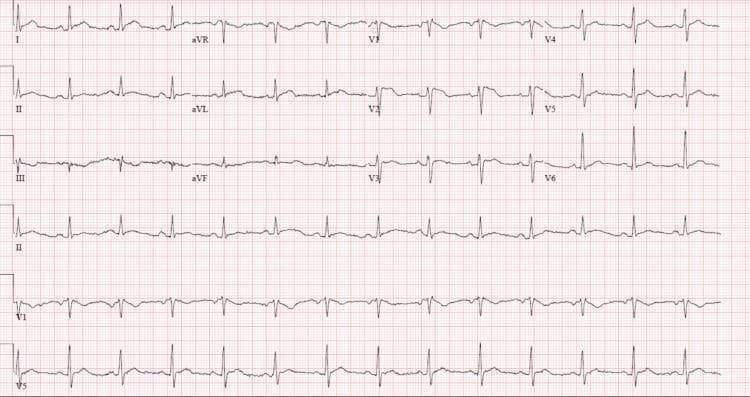 A standard 12-lead electrocardiogram (ECG) displayed on a pink grid, showing the standard limb leads (I, II, III), augmented limb leads (aVR, aVL, aVF), and precordial leads (V1-V6), with additional rhythm strips at the bottom for leads II, V1, and V5. The ECG demonstrates a normal sinus rhythm with a regular rate. Waveform analysis shows normal QRS morphology and duration across most leads. Notable diagnostic features include findings suggestive of left atrial enlargement, evidenced by notched or prolonged P-waves in some leads (P mitrale). There is no significant ST-segment elevation or depression, and the T-waves appear largely unremarkable. Precordial leads V1 through V6 show a normal R-wave progression. This diagnostic image is used in clinical medicine to assess cardiac electrical activity, heart rate, rhythm, and potential chamber enlargement.