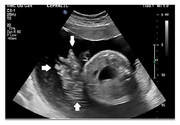 This obstetric ultrasound image, captured in a transverse plane, illustrates a rare clinical finding of active fetal hemorrhage. The central anatomical landmark is a cross-section of the fetal abdomen, characterized by a circular structure with a prominent anechoic (dark) internal region representing the fetal stomach or bladder. White arrows indicate a region of heterogeneous, echogenic swirling fluid within the normally anechoic amniotic cavity. This visual phenomenon represents blood emanating from the umbilical cord, which is seen adjacent to the fetal body. The echogenicity of the blood is notably higher than the surrounding amniotic fluid, indicating particulate matter (red blood cells) in motion. Superior to the fetus, the placental plate is visible as a moderately echogenic, curved boundary. This image is of high clinical significance for identifying spontaneous umbilical cord hemorrhage, a life-threatening obstetric emergency often associated with umbilical cord abnormalities such as a lack of Wharton's jelly or vessel exposure.