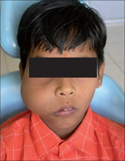 A clinical photograph of a pediatric male patient demonstrating significant facial asymmetry due to a large, diffuse swelling on the right midface. The swelling originates from the right maxilla and extends from the infraorbital region down to the mandible, and laterally from the nasolabial fold toward the preauricular area. Visually, the mass causes a superior displacement of the right lower eyelid and eyeball (proptosis/exophthalmos) and an upward elevation of the right corner of the mouth. The overlying skin appears intact with normal color and texture, suggesting a deep-seated, slow-growing pathology. The case is consistent with an odontogenic tumor or fibro-osseous lesion of the maxilla, such as an odontogenic myxoma, causing extensive bony expansion and secondary displacement of orbital and perioral soft tissue structures. This image serves as a clinical example of maxillo-facial pathology and its impact on cranial symmetry and orbital alignment.