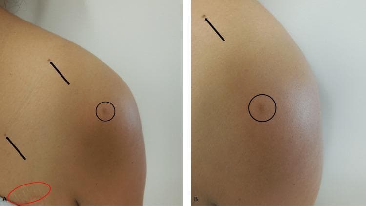Clinical photograph (two-panel comparison) showing a dermatofibroma and associated skin findings on the left shoulder and chest of a 37-year-old woman. Panel A (distant view) and Panel B (close-up view) feature a primary lesion indicated by a black circle: a 5 x 5-millimeter, tan-colored, slightly raised dermal nodule. The lesion is firm and clinically consistent with a fibrocollagenous variant of dermatofibroma. Secondary findings highlighted with black arrows include small, dark, well-demarcated pigmented macules consistent with junctional nevi located on the shoulder and chest. In Panel A, a red oval demarcates a linear, hypopigmented area on the upper chest representing a healed surgical scar. The surrounding skin is otherwise normal in appearance. This image is used to demonstrate the clinical presentation of benign skin neoplasms in an immunosuppressed patient (post-liver transplant), emphasizing the morphology and distribution of dermatofibromas and nevi.