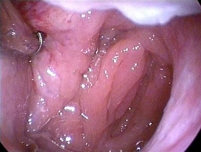 This endoscopic clinical photograph demonstrates a Balloon Eustachian Tuboplasty (BET) procedure. The image provides an internal view of the nasopharynx, focusing on the pharyngeal orifice of the Eustachian tube. The surrounding mucosa is pinkish-red, moist, and glistening, with natural anatomical folds visible. A specialized 600 µm balloon catheter is seen positioned at the entrance of the Eustachian tube. On the left side of the field, a metallic, semi-circular instrument or guide is visible, characterized by its silver, reflective surface. The educational focus of this image is the visualization of the nasopharyngeal anatomy during the insertion phase of a balloon dilation procedure intended to treat Eustachian tube dysfunction. The procedure typically involves advancing the catheter 2 cm into the tube and inflating the balloon to a pressure of 10 bars using saline solution to facilitate dilation and improve middle ear ventilation.