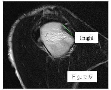 This diagnostic image is a CT scan in a sagittal view focused on the humeral head of the shoulder. It demonstrates a Hill-Sachs lesion, which is a posterolateral compression fracture of the humeral head typically resulting from anterior shoulder dislocation. The image shows a cortical depression or defect on the posterior-superior aspect of the bone. A green solid line spans the edge of the indentation to measure the length of the lesion, which is an important clinical parameter in determining shoulder instability and surgical planning (on-track versus off-track lesions). The high-contrast bone appears bright against the surrounding darker soft tissues, highlighting the altered morphology of the articular surface. This visual aid is intended for intermediate to advanced orthopedic or radiological education regarding the quantification of glenohumeral joint trauma.