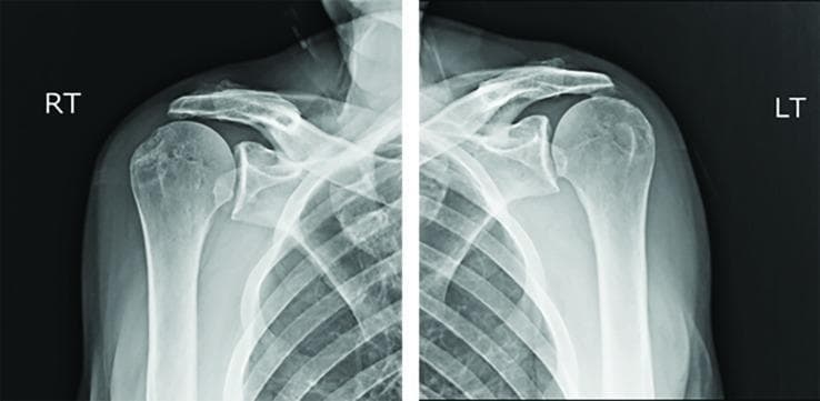 This diagnostic image consists of two anteroposterior (AP) radiographs of the right (RT) and left (LT) shoulders. The primary finding is bilateral superior migration of the humeral heads relative to the glenoid fossae, commonly referred to as high-riding humeral heads. This positioning significantly reduces the subacromial space, indicating a high likelihood of massive rotator cuff tears where the stabilizing downward force of the cuff is lost, allowing the deltoid to pull the humerus superiorly. Despite the superior translation, the glenohumeral joints remain concentrically reduced, with articular surface contact maintained. The bony structures, including the clavicles, scapulae (acromion and coracoid processes), and proximal humeri, appear intact without evidence of acute fractures or dislocations. There is visible cystic change or remodeling on the greater tuberosity of the right humerus, often associated with chronic tendinopathy or previous avulsion. This visual is characteristic of rotator cuff arthropathy and is a critical teaching tool for identifying indirect signs of soft tissue injury on plain film radiography.