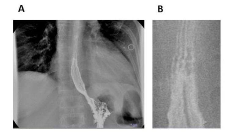 This diagnostic image set features a videofluoroscopic swallowing study and esophageal transit evaluation using barium contrast. Image A presents a posterior-anterior fluoroscopic view of the thoracic esophagus, revealing an altered esophageal profile characterized by a mildly spiculed or serrated outline along its margins, rather than a smooth mucosal surface. Image B provides a magnified detail of the proximal barium column, where subtle horizontal lines are visible across the esophageal lumen. These radiographic findings, known as 'feline esophagus' or transient esophageal rings, are classic markers of eosinophilic esophagitis (EoE). The images demonstrate the use of contrast radiography in detecting structural and mucosal changes associated with chronic esophageal inflammation, assisting in the differentiation of motility disorders and inflammatory conditions. This content is suitable for medical students and gastroenterology specialists studying diagnostic imaging of dysphagia and esophageal pathologies.