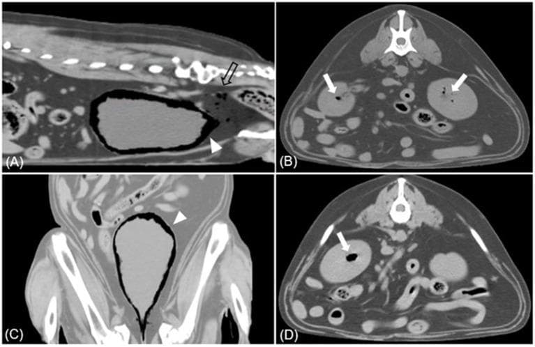 This composite of Computed Tomography (CT) images illustrates a case of severe emphysematous infection within the urinary tract. Images A (sagittal) and C (dorsal) show the urinary bladder with significant intramural and intraluminal gas accumulations (white arrowheads), characteristic of emphysematous cystitis. Additionally, an empty arrow in panel A highlights free gas pockets (pneumoperitoneum/pneumoretroperitoneum) located in the pelvic cavity posterior to the bladder. Images B and D (transverse views) demonstrate bilateral emphysematous pyelonephritis (EPN), indicated by white arrows pointing to multifocal gas bubbles within the renal parenchyma and pelvis of both kidneys. The gas appears as hypoattenuating (black) rounded and irregular shapes against the soft-tissue density of the urinary organs. These findings are critical diagnostic markers for necrotizing gas-forming infections, often associated with organisms like Escherichia coli. The study is optimized for a soft tissue window, providing clear contrast between abnormal gas pockets and the surrounding anatomical structures.