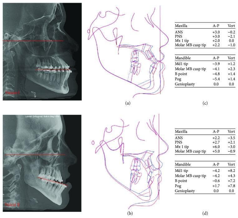Educational visual regarding orthognathic surgery planning for Class III malocclusion, featuring lateral cephalometric analysis for two patients. The left column displays lateral radiographs (Patient I and II) with red lines highlighting the occlusal plane (OP) and Frankfort horizontal plane, demonstrating variations in OP inclination. The center column (a, b) provides superimpositions of original (blue) and predictive (red) cephalometric tracings, illustrating planned maxillomandibular complex (MMC) movements, including clockwise and counterclockwise rotations. The right column (c, d) contains quantitative data tables detailing anticipated anterior-posterior (A-P) and vertical (Vert) surgical changes for anatomical landmarks such as the ANS, PNS, B-point, and Pogonion. This comparison highlights how different facial morphotypes (brachycephalic vs. dolichocephalic) influence the surgical strategy to optimize facial harmony, chin projection, and the mandibular contour.