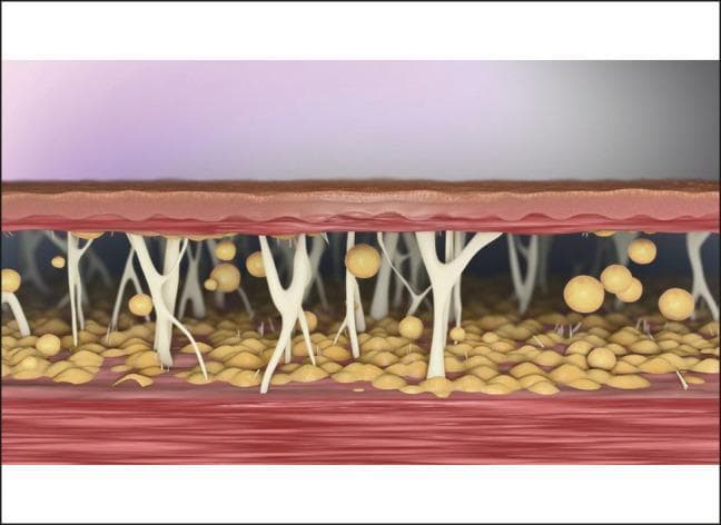 This medical illustration provides a cross-sectional view of the human integumentary system, focusing on the anatomy of the subcutaneous layer following a liposuction procedure. The diagram depicts the epidermis and dermis as thin, stratified upper layers. Beneath the dermis lies the hypodermis (subcutaneous tissue), characterized by prominent fibrous septae—white, branching connective tissue strands that tether the dermis to the underlying deep fascia and muscle tissue (shown at the bottom in red). Yellowish, spherical lobules representing adipocytes (fat cells) are interspersed within this structural framework. The image highlights a post-liposuction state where a significant portion of the fat volume has been removed, leaving behind the vertical and oblique connective tissue network. This visual emphasizes the relationship between the skin, the scaffolding of the subcutaneous connective tissue, and the residual fat, illustrating why additional treatments may be required to address tissue laxity when these supporting strands do not spontaneously contract after fat aspiration. The content is designed for intermediate to advanced learners in plastic surgery or dermatology to understand the structural mechanics of soft tissue contraction.