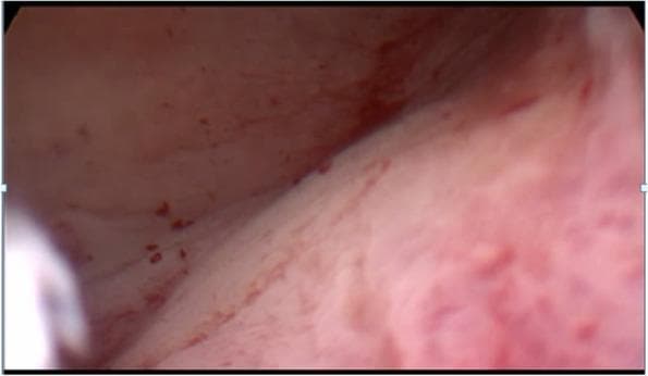 This clinical photograph shows a hysteroscopic view of a healthy-appearing endometrial cavity. The uterine lining is visualized as a pale pink to reddish mucosa with a smooth, uniform texture. Fine, branching vascular patterns are evident across the surface, along with small, scattered punctate reddish spots representing superficial capillaries or minor surface irregularities. No visible intraluminal pathologies are present; specifically, there are no polyps, submucosal fibroids, or structural distortions of the cavity. This image serves as a clinical reference for a normal uterine interior in the context of FIGO Type 3 intramural fibroids, which are known to abut the endometrium without causing visible intracavitary alterations. The anatomical focus is on the endometrial surface during a diagnostic hysteroscopy in an adult female patient, used to differentiate between cavity-distorting and non-distorting uterine myomas.