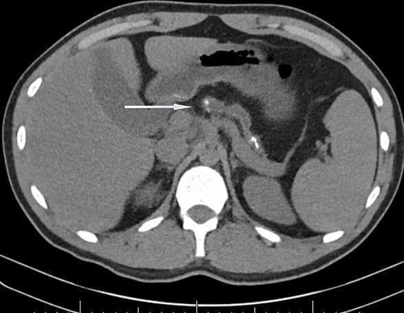 This axial abdominal CT scan demonstrates classic findings of severe chronic pancreatitis. The primary pathological finding is marked parenchymal atrophy of the pancreas, which is significantly reduced in size. Scattered throughout the remaining pancreatic tissue are multiple hyperdense, sub-centimeter calcifications. A white arrow points to a prominently dilated pancreatic duct (ductal ectasia) containing intraductal calculi (stones). Surrounding anatomy is clearly visible, including the liver in the right upper quadrant, the spleen in the left upper quadrant, and the stomach located anterior to the pancreas. The vertebral body and dorsal musculature are visible posteriorly. This imaging modality is essential for identifying structural changes associated with long-standing pancreatic inflammation, such as those found in hereditary or obstructive chronic pancreatitis. The presence of ductal dilation and diffuse calcification are hallmark diagnostic features of end-stage chronic pancreatic disease.