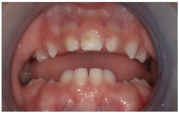 This clinical photograph displays an intraoral view of a pediatric patient's dentition, highlighting a solitary median maxillary central incisor (SMMCI). A single, symmetrically positioned, broad rectangular incisor is visible at the maxillary midline, replacing the normal pair of central incisors. The tooth crown shows a subtle, small yellow focal discoloration on the labial surface. The surrounding gingiva and oral mucosa appear healthy, moist, and pink without signs of inflammation. The palate exhibits a high-arched, ogival morphology with a prominent anterior vertex. This finding is a key clinical marker often associated with midline developmental anomalies such as congenital nasal pyriform aperture stenosis (CNPAS) or holoprosencephaly (HPE) spectrum. The mandibular dentition shows typical primary incisors with normal spacing. The image serves as an educational example of dental dysmorphology related to genetic syndromes involving midline facial development.