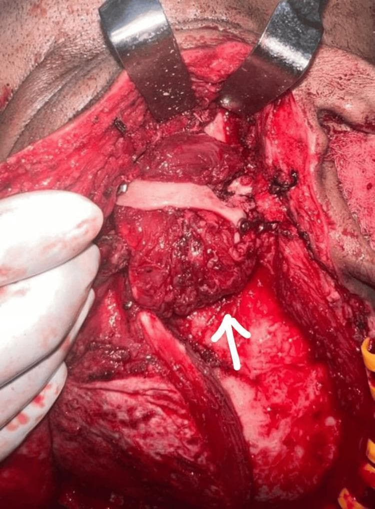This clinical photograph captures an intraoperative view of an interpositional gap arthroplasty of the temporomandibular joint (TMJ). The surgical site is exposed via a hemicoronal approach, with two metal retractors at the superior margin providing visualization. A white arrow indicates the interpositional material—a temporalis muscle myofascial flap—which has been rotated and positioned into the arthroplasty gap to prevent bony re-ankylosis. Adjacent to the muscle graft, a titanium bone plate and several fixation screws are visible, used for the reconstruction and stabilization of the zygomatic arch. The surgical field demonstrates raw, vascularized tissue and anatomical landmarks relevant to maxillofacial reconstruction, including the temporal fossa and preauricular regions. Visible sutures and surgical gloves indicate the active procedural stage. This image serves as an educational reference for surgical management of TMJ ankylosis and the use of autogenous tissue grafts in joint reconstruction.