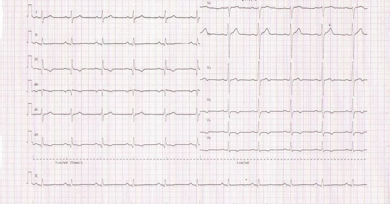 A standard 12-lead electrocardiogram (ECG) recording displayed on pink-grid thermal paper. The layout is organized into two main columns: the left column contains limb leads I, II, III, aVR, aVL, and aVF, while the right column contains precordial leads V1 through V6. A rhythm strip (lead II) is positioned along the bottom. The grid features standard 1 mm small squares and 5 mm large squares for amplitude and time measurement. Calibration markers are visible at the start of each row, with scaling indicated at 1 cm/mV and 25 mm/s. The recording illustrates a normal sinus rhythm with clearly visible P waves, QRS complexes, and T waves. Typical R-wave progression is observed across the precordial leads (V1-V6). Minor baseline fluctuations and electrical artifacts are present, particularly in leads II and III. This diagnostic image serves as a fundamental clinical tool for assessing cardiac rhythm, rate, and conduction abnormalities in cardiology education.