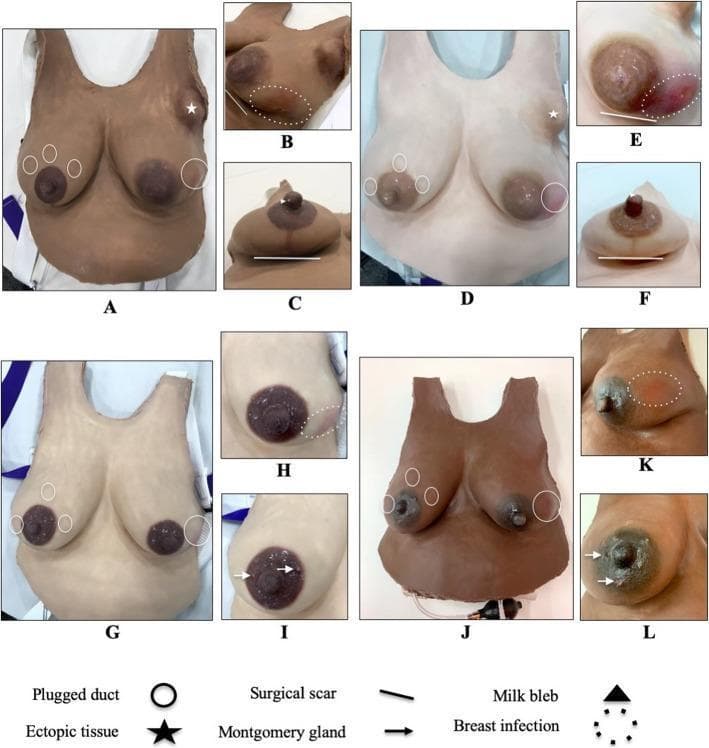 This clinical comparison chart displays various Lactation Simulation Models (LSM) designed for medical education, shown in multiple skin tones. The visual provides examples of breast anatomy, lactation-related pathologies, and surgical history relevant to obstetrics, gynecology, and breastfeeding medicine. Key anatomical variations depicted include round, pinched, flat, and bulbous nipple morphologies. Pathological signs illustrated include mastitis (breast infection), indicated by erythema; plugged ducts, represented by palpable nodules; milk blebs; and Montgomery glands. Additionally, the models demonstrate surgical markers such as augmentation and reduction scars, as well as axillary ectopic breast tissue. Annotation symbols (circles, stars, lines, and arrows) are used throughout the panels to identify specific clinical findings. The collection serves as an educational tool for training healthcare providers in breast examination, lactation assessment, and the identification of both normal variations and common breastfeeding complications.