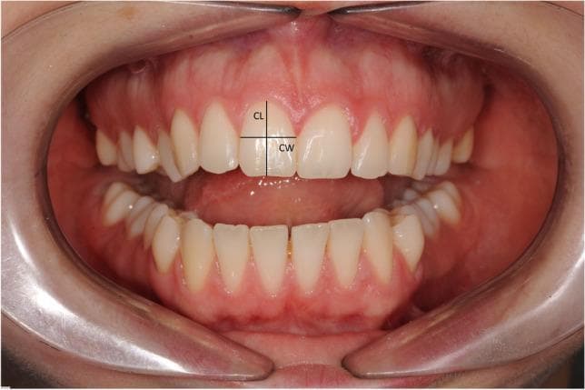 A frontal intraoral clinical photograph showing the maxillary and mandibular dental arches in a slightly open position, maintained by clear cheek retractors. The focus is on the crown morphology of the maxillary central incisors. The image displays linear measurement annotations on the right maxillary central incisor: Crown Length (CL), represented by a vertical line from the incisal edge to the gingival margin, and Crown Width (CW), represented by a horizontal line across the widest part of the tooth between the approximal surfaces. The gingival tissue appears healthy and pink with intact interdental papillae. The primary educational objective is to illustrate the parameters used to calculate the width-to-length ratio (W/L), a key metric in esthetic dentistry and orthodontics for assessing tooth proportions and the impact of crown morphology on periodontal outcomes, such as papilla recession following maxillary expansion.