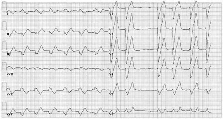 A 12-lead electrocardiogram (ECG) demonstrating the co-occurrence of atrial fibrillation and rate-dependent left bundle branch block (LBBB). The rhythm is irregularly irregular with an absence of discernible P waves, replaced by fine fibrillatory undulations of the baseline, characteristic of atrial fibrillation. The QRS complexes are significantly widened (greater than 120 ms), indicating an intraventricular conduction delay. In the precordial leads V1-V3, there is a predominantly negative, wide, and notched QRS morphology. The lateral leads (I, aVL, V5, and V6) show tall, broad, and slurred R-waves. Secondary ST-T wave changes are visible, including ST-segment depression and T-wave inversion in the lateral leads, which are discordant to the QRS polarity. This pattern is consistent with a complete left bundle branch block. The ECG serves as an educational example of how metabolic derangements, such as hyperkalemia, or physiological triggers like increased heart rate, can precipitate conduction abnormalities in a patient with underlying atrial arrhythmia.