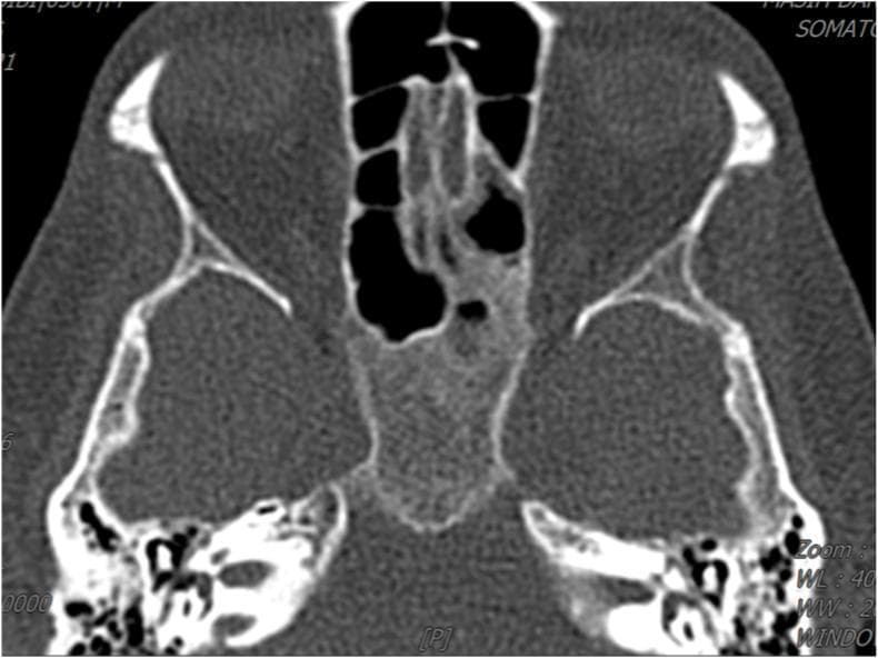 An axial non-contrast computed tomography (CT) scan of the paranasal sinuses at the level of the ethmoidal and maxillary regions. The image demonstrates significant bilateral mucosal thickening and opacification involving the maxillary sinuses and the ethmoidal air cells. These regions exhibit soft tissue density (intermediate gray) replacing the normal dark, air-filled spaces. The opacification appears diffuse, with notable involvement of the posterior ethmoid cells. The surrounding bony architecture, including the orbital walls and nasal septum, remains visible. Clinically, such findings in the context of a diabetic or immunocompromised patient are suggestive of severe inflammatory or infectious processes, such as acute rhinosinusitis or invasive fungal sinusitis (e.g., aspergillosis). This diagnostic image is essential for evaluating the extent of sinus disease and assessing for potential bony erosion or orbital extension in ENT and radiology education.