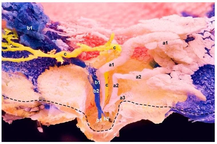This clinical photograph displays a sagittal plane of a resin-casted mammary gland, illustrating the complex internal anatomy of milk ducts and glandular compartments. The specimen features three distinct color-coded resin applications (a, b, c) injected into separate teat orifices to map ductal pathways. Compartment 'a' (white) shows multiple functional ducts (a1, a2) with significant branching that leads to glandular lobes, alongside a blind-ended duct (a3). Compartment 'b' (blue) demonstrates multiple ducts (b1, b2) originating from two orifices that coalesce at a sharp curvature point before ascending. Compartment 'c' (yellow) illustrates a single, linear duct draining a single compartment without extensive branching or attached alveoli. A dashed line indicates the preserved superficial skin layer. This anatomical preparation highlights the high degree of variation in ductal morphology, showing that teat ducts can be solitary or split into multiple sections, and demonstrating the in situ spatial relationships between different glandular compartments which may overlap without mixing their ductal systems.