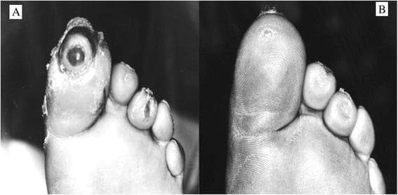 This clinical comparison photograph demonstrates the progression of diabetic foot ulcer healing on the distal aspect of the toes. Image A (baseline) shows a large, deep circular ulcer on the tip of the hallux (great toe) with exposed underlying tissue and irregular, macerated edges. Smaller, superficial ulcers or skin erosions are also visible on the tips of the second and third digits. The nail plate of the hallux appears absent or significantly degraded. Image B (follow-up) illustrates complete re-epithelialization and wound closure across all affected areas. The hallux now displays intact skin with restored dermatoglyphic patterns and a smooth texture, indicating successful tissue repair. The adjacent toes also show resolved skin lesions. This comparison is used to illustrate the efficacy of wound care interventions in managing neuropathic or ischemic diabetic foot ulcers, highlighting the transition from an open, Wagner-graded wound to a fully healed state with restored skin integrity.