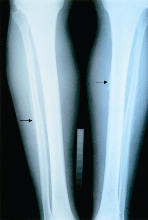 This diagnostic X-ray (radiograph) demonstrates the bilateral lower legs, specifically the tibiae and fibulae, of a patient with Stage II skeletal fluorosis. The image illustrates key osteosclerotic changes and cortical abnormalities characteristic of chronic fluoride toxicity. Visible findings include a general thinning of the diaphyseal regions and notable ill-defined or blurred cortical margins, highlighted by black arrows. Unlike the sharp demarcation seen in healthy bone, these margins appear irregular, suggesting periosteal reaction or subperiosteal bone formation. The educational focus is on identifying the skeletal manifestations of fluorosis, which often present with increased bone density (osteosclerosis), coarsening of the trabecular pattern, and potential calcification of interosseous membranes or ligaments. This radiographic study serves as a clinical example of occupational or environmental toxicological pathology affecting the appendicular skeleton.