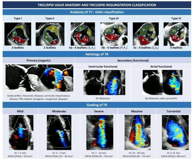 Educational infographic regarding tricuspid valve (TV) anatomy and tricuspid regurgitation (TR) classification. The top section illustrates the Hahn classification of TV anatomy via en-face echocardiographic views, categorizing valves by leaflet count: Type I (3 leaflets: A, P, S), Type II (2 leaflets), Type III (4 leaflets, further divided into IIIa, IIIb, and IIIc based on split anterior, posterior, or septal leaflets), and Type IV (5 leaflets). The middle section depicts TR aetiology, distinguishing between Primary (organic causes like endocarditis or rheumatic disease) and Secondary/Functional (Ventricular functional with RV dilatation vs. Atrial functional with RA dilatation and normal RV). The bottom section provides a five-class grading scheme for TR severity (Mild, Moderate, Severe, Massive, and Torrential) using color Doppler flow imaging. Each grade is defined by specific quantitative metrics: Vena Contracta (VC) ranging from <3 mm (Mild) to ≥21 mm (Torrential) and Effective Regurgitant Orifice Area (EROA) via the PISA method, ranging from <20 mm² (Mild) to ≥80 mm² (Torrential).