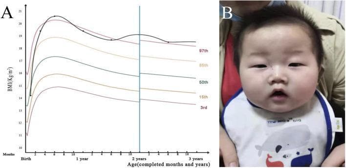 This composite educational graphic includes a growth chart (Panel A) and a clinical photograph (Panel B) illustrating phenotypic features associated with a genetic developmental disorder. Panel A displays a longitudinal Body Mass Index (BMI) growth curve from birth to 3 years. The patient's BMI (black line) shows a rapid ascent following birth, remaining consistently above the 97th percentile, indicating childhood obesity. Panel B is a frontal clinical photograph of an infant demonstrating characteristic dysmorphic features. Visible signs include macrocephaly (large head circumference), a prominent forehead (frontal bossing), and a significantly plump, rounded face with full cheeks. Ocular findings include small palpebral fissures (narrowed eye openings) and hypertelorism (increased distance between the eyes). The mouth exhibits downturned corners, contributing to a triangular-shaped lower facial contour. The neck appears shortened. These findings are clinically relevant for the assessment of syndromic obesity and global developmental delay, specifically in the context of TCF20-related neurodevelopmental disorders.