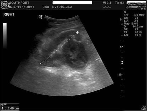 This diagnostic abdominal ultrasound image displays the right kidney in a longitudinal view, demonstrating moderate to severe hydronephrosis. The renal pelvis and collecting system are grossly dilated, appearing as a large, central anechoic (fluid-filled) region. Notably, the dilated space contains thick, hyperechoic (bright) linear internal septations and heterogeneous echogenic debris, which are hallmark sonographic signs of pyonephrosis (infected hydronephrosis). Electronic calipers measure the kidney's longitudinal axis at approximately 8.49 cm. The renal parenchyma appears thinned, suggesting chronic pressure from the dilated collecting system. The surrounding retroperitoneal tissues show a normal speckled echotexture. This image serves as a critical educational example of complicated urinary tract obstruction where fluid stasis has progressed to suppuration, requiring urgent clinical intervention like drainage or nephrostomy.