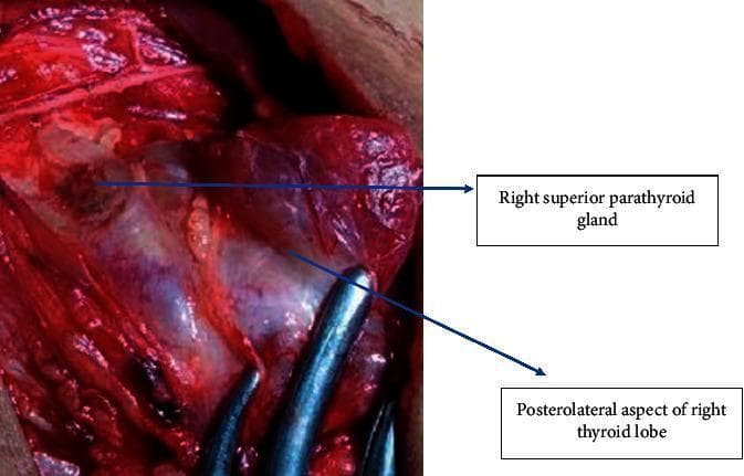 This clinical photograph captures an intraoperative view during a thyroidectomy, specifically highlighting the surgical identification of the parathyroid glands. The image focuses on the right surgical field where the right thyroid lobe is being retracted medially and anteriorly using surgical forceps. Labeled in the upper portion of the field is the right superior parathyroid gland, which presents as a small, ovoid, reddish-brown structure. It is situated on the posterolateral aspect of the right thyroid lobe, demonstrating its characteristic anatomical location superior to the entry of the inferior thyroid artery and posterior to the recurrent laryngeal nerve's expected course. The surrounding tissue shows rich vascularization and connective tissue planes typical of the neck's central compartment. This visual serves as a critical educational resource for endocrine surgeons and medical students to understand the delicate anatomy and visual cues—such as color and texture—required to identify and preserve parathyroid glands during thyroid surgery to prevent postoperative hypocalcemia.
