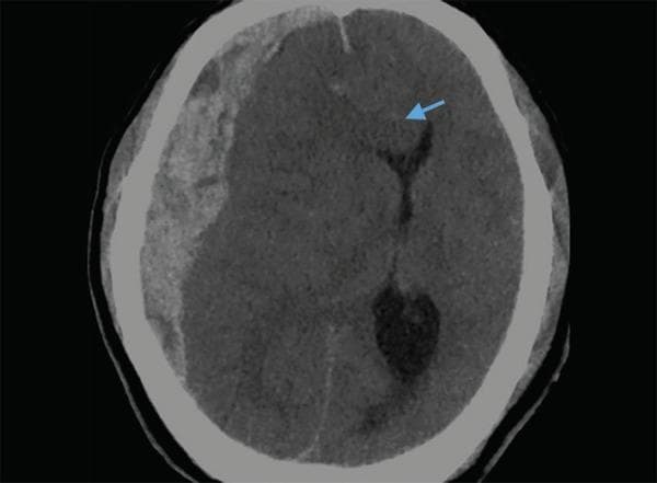 This diagnostic axial non-contrast CT scan of the brain demonstrates an acute subdural hematoma (SDH) in the right frontoparietal region. The visual features include a hyperdense, crescentic (concavo-convex) extra-axial collection extending along the inner table of the calvarium. The hematoma exerts significant mass effect on the underlying brain parenchyma, resulting in a marked leftward midline shift. A blue arrow identifies subfalcine herniation, where the cingulate gyrus is displaced across the midline beneath the falx cerebri. There is also evident effacement of the ipsilateral (right) lateral ventricle and cortical sulci, accompanied by surrounding hypodense areas consistent with cerebral edema. This image serves as an educational example of acute traumatic intracranial hemorrhage and secondary brain herniation syndromes, highlighting the critical radiological signs used in neurosurgical triage and emergency medicine.
