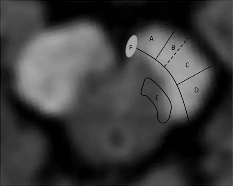 This diagnostic axial MRI scan of the midbrain features a schematic overlay illustrating the topographical functional anatomy of the cerebral peduncle (crus cerebri). The labeled regions (A–F) represent specific descending and ascending tracts. Areas A, B, C, and D are arranged segmentally along the ventral-lateral arc of the peduncle: Area A (medial) contains the corticoponto cerebellar tract (CPCT); Area B corresponds to the corticonuclear tract; Area C represents the corticospinal tract (CST); and Area D (lateral) includes the parieto-, temporo-, and occipitopontine tracts. Region E, located dorsomedial to the main peduncular segments, corresponds to the spinothalamic tract and medial lemniscus. Small oval Area F, situated at the most medial border of the peduncle, indicates the location of the oculomotor nerve (CN III) fibers. This diagram is educationally significant for correlating specific neurological deficits, such as ataxia (A), hemiparesis (C), and sensory disturbances (E), with localized infarcts or lesions within the midbrain peduncular architecture.