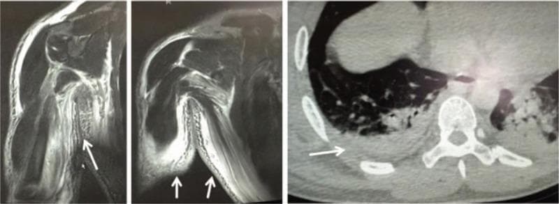 This composite diagnostic image includes magnetic resonance imaging (MRI) and computed tomography (CT) scans demonstrating extensive soft tissue pathology. The left and middle panels consist of MRI scans of the right upper extremity, showing significant soft tissue swelling and abnormal high-signal intensity (edema) within the subcutaneous and intermuscular fascial planes (white arrows). These findings are indicative of fluid accumulation and inflammatory changes consistent with necrotizing fasciitis or severe cellulitis. The right panel is an axial CT scan of the thoracic region, revealing substantial soft tissue thickening and edema along the right thoracic wall (white arrow). There is visible fluid collection in the muscle spaces and a notable loss of distinct fascial margins. The underlying lung parenchyma also shows some consolidative changes. The combined imaging highlights the rapid progression of soft tissue infection and inflammatory edema across multiple anatomical regions, including the forearm and trunk.