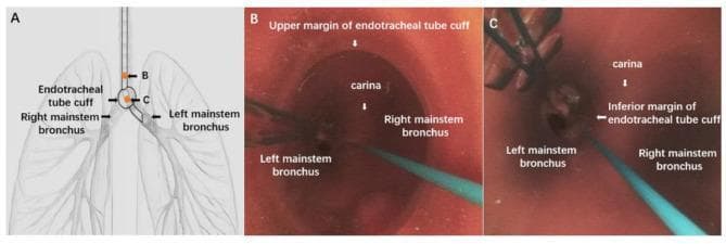 This composite educational resource illustrates the positioning of an endotracheal tube (ETT) for lung isolation and hemorrhage control. Panel A is an anatomical diagram showing the ETT tip positioned within the left mainstem bronchus, with the inflated cuff situated at the carina to isolate the right lung. Panels B and C are bronchoscopic images captured via a flexible electronic bronchoscope. Image B demonstrates the view from within the trachea, showing the upper margin of the inflated ETT cuff, the carina, and the openings to the left and right mainstem bronchi. Image C provides a view from a more distal position, identifying the carina and the inferior margin of the cuff as it sits at the tracheal bifurcation. This content is designed to teach airway management, one-lung ventilation techniques, and compression hemostasis protocols for managing massive hemoptysis or pulmonary hemorrhage.