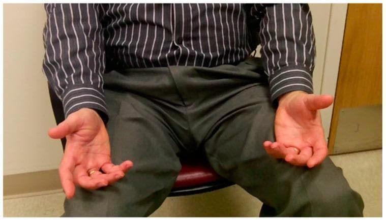 Clinical photograph of a patient exhibiting focal hand dystonia (FHD) at rest. The image shows a seated individual with both hands held in an abnormal, involuntary posture. The hands are positioned in front of the torso with palms facing medially. There is evidence of dystonic posturing characterized by partial flexion at the metacarpophalangeal (MCP) joints and more pronounced flexion at the proximal and distal interphalangeal (IP) joints of the fingers, particularly involving the third through fifth digits. The thumbs show subtle extension at the MCP joints with flexion at the IP joints. The wrists are maintained in a neutral to slightly extended position. This bilateral presentation illustrates the characteristic muscle co-contractions and tonic posturing associated with dystonia, used here to demonstrate a severe case where symptoms are present even without task-specific provocation. This clinical visual serves as an educational tool for neurology and physical therapy in identifying movement disorders and functional anatomy abnormalities during physical examination.
