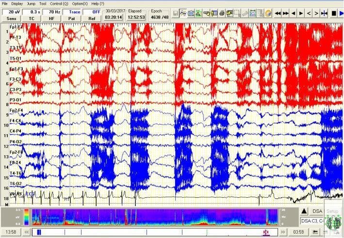 This diagnostic image displays a 30-second compressed video-EEG segment captured during a focal seizure evolving into a generalized event. The EEG layout uses a longitudinal bipolar montage, with upper channels (1-7) highlighted in red and lower channels (9-16) in blue. The tracing demonstrates high-amplitude, rhythmic ictal discharges consisting of spiky theta and alpha frequencies, particularly prominent in the left temporal regions (F7-T3, T3-T5). These discharges are accompanied by intermittent bursts of generalized high-voltage activity. Channel 17 shows a simultaneous single-lead ECG recording. Clinical significance is highlighted by the temporal correlation between the ictal EEG activity and a period of cardiac asystole, evidenced by a prolonged flatline on the ECG following initial bradycardia. This visual illustrates the rare but critical phenomenon of ictal asystole, an autonomic complication of epilepsy. A Density Spectral Array (DSA) is provided at the bottom of the interface, visualizing power distribution over time.