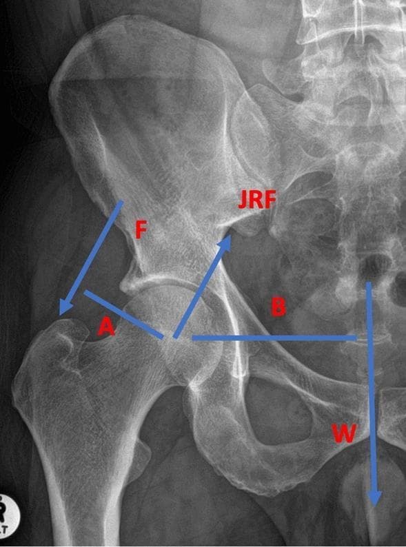 This diagnostic image is an anteroposterior (AP) X-ray of the human right hip joint integrated with a biomechanical free body diagram. Anatomical structures clearly visible include the proximal femur (head, neck, and greater trochanter), the acetabulum of the pelvis, the ilium, and the lower lumbar spine. The diagram overlays several vectors and moment arms to illustrate hip joint loading. The arrow labeled 'F' represents the abductor muscle force acting from the ilium toward the greater trochanter. 'W' denotes the downward force of body weight. 'JRF' indicates the Joint Reaction Force acting across the femoral head and acetabulum. Two blue lines, 'A' and 'B', represent the moment arms for the abductor muscles and body weight, respectively, calculated from the center of rotation of the femoral head. This educational visual is used in orthopedic biomechanics to explain how muscle forces and body weight interact to determine joint stress, which is critical for understanding the pathophysiology of osteoarthritis or the mechanical consequences of corrective osteotomies.
